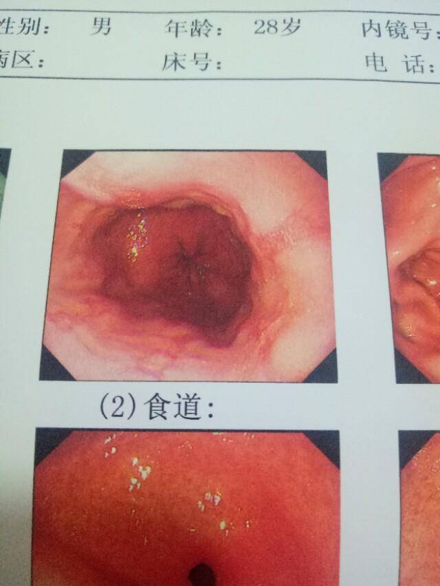 胃食管反流病