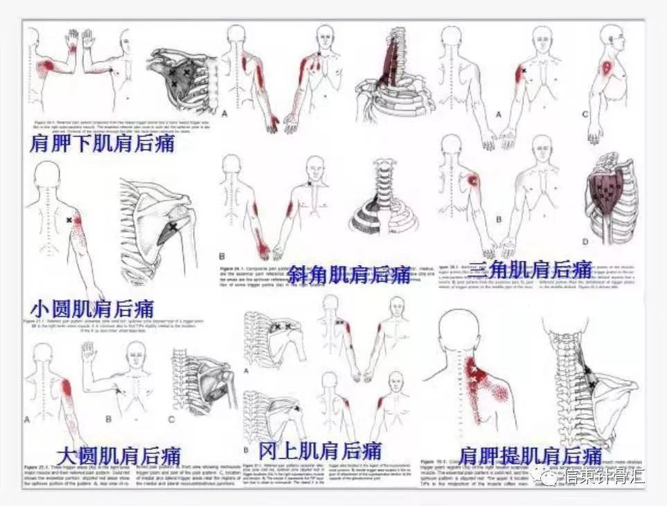 肌筋膜全身160个疼痛触发点