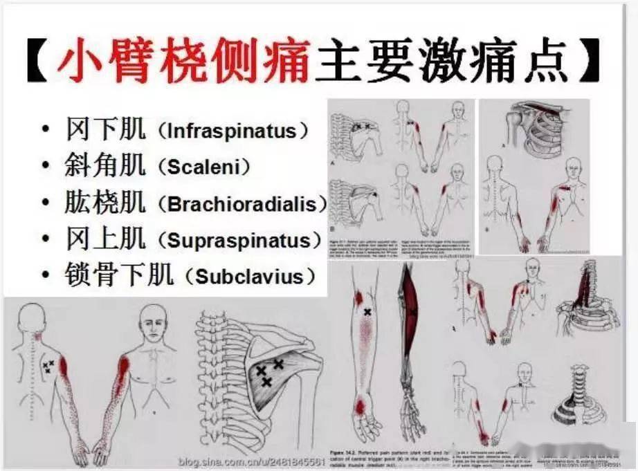 肌筋膜全身160个疼痛触发点