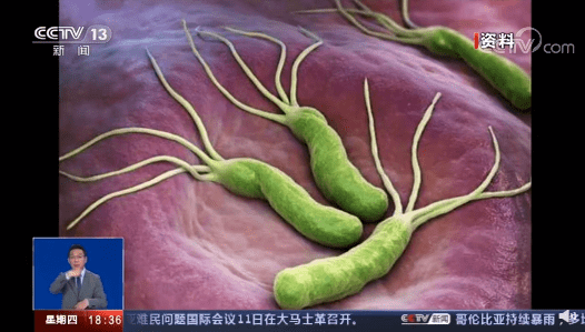 检测|无症状也要根除治疗！ 感染幽门螺杆菌胃里一定有炎症