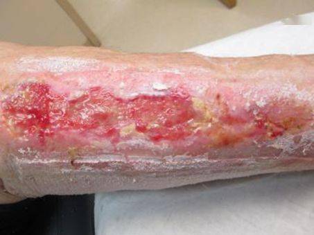 伤口周围脆弱皮肤的评估和管理