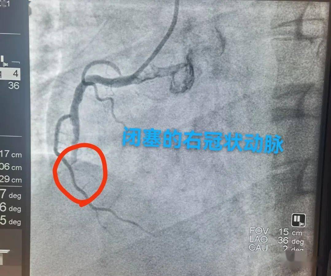 36歲的年紀,全部心臟血管都已經出現問題,一根迴旋支閉塞了,一根右