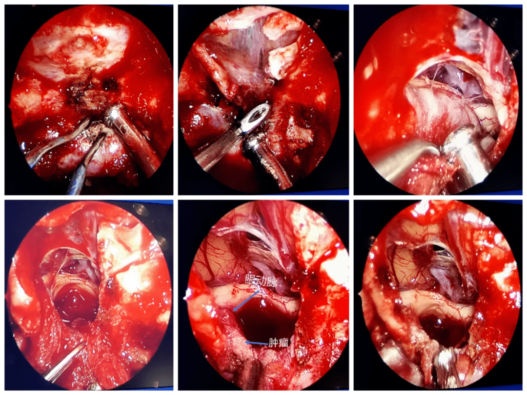 部分应该是肿瘤的起源,与硬膜关系密切,ica主干就在肿瘤的外侧,视神经