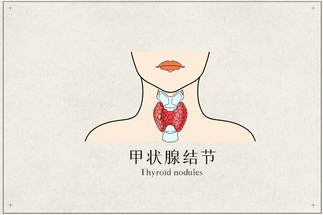 癥狀|知名女演員被查出癌癥，才剛剛30歲！這種癌癥越來越年輕化！醫生緊急提醒...