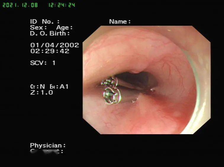 【医疗技术】反复吞咽困难两年多,内镜poem技术解忧愁_食管_贲门_治疗