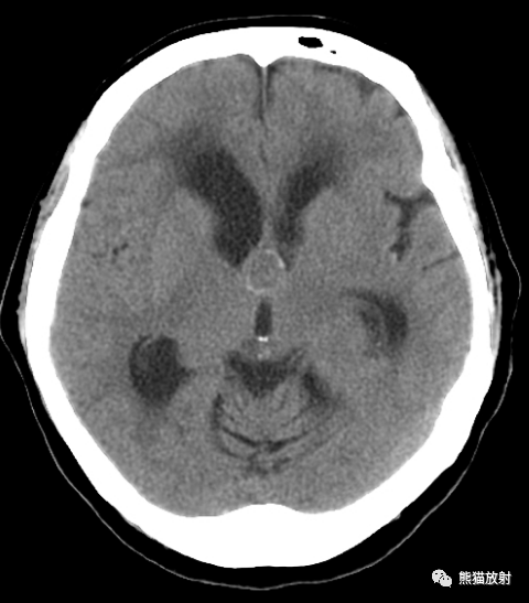 成人)pediatricchoroid plexus papilloma 脉络丛乳头状瘤adamantino