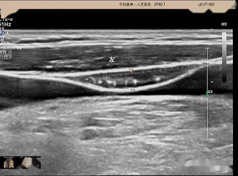 超声问答61这个颈部淋巴结应该如何考虑?