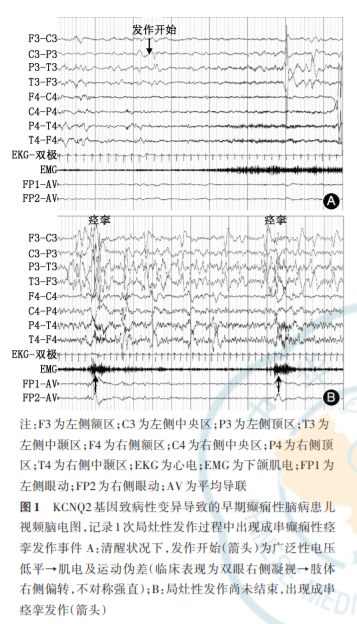 神经系统疾病研究新生儿期一次发作事件中癫痫性痉挛与