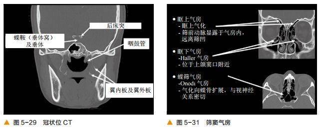 二,冠狀位圖像一,軸位圖像顱底ct及鼻竇解剖胡業帥博士整理自鼻內鏡