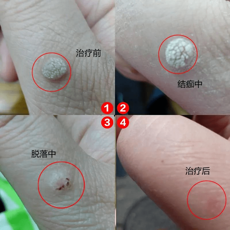 水疣是什么症状图片图片