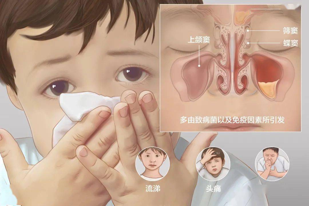 儿童鼻炎内部图片图片