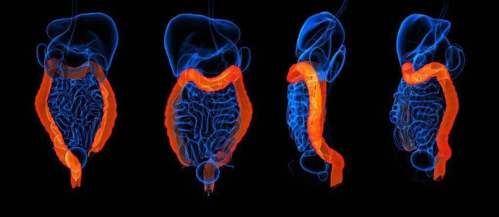 肿瘤|BJC：他汀防癌的“开关”找到了！科学家再次发现，他汀的使用与肠癌风险降低有关，获益人群或表达一个特定基因丨临床大发现