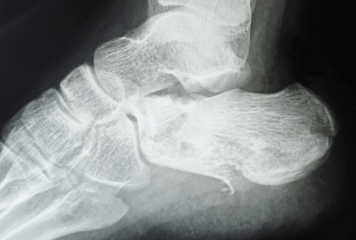 时间|3D数字医学结合微创，精准治疗跟骨粉碎性骨折