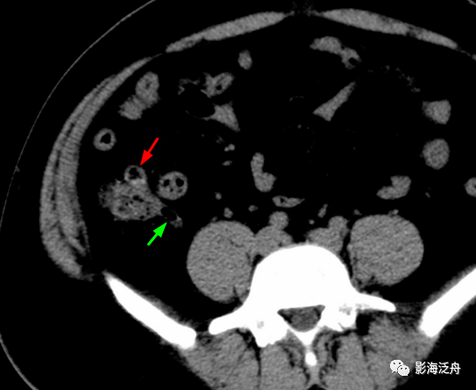 回盲部多发憩室图片图片