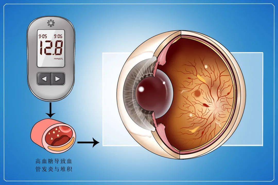 血管|健康丨糖尿病不只是血糖高那么简单