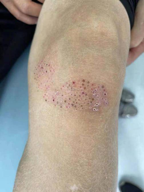 老寒腿变天就现梅花点,保守治疗或将加重病情_膝关节_软骨_症状