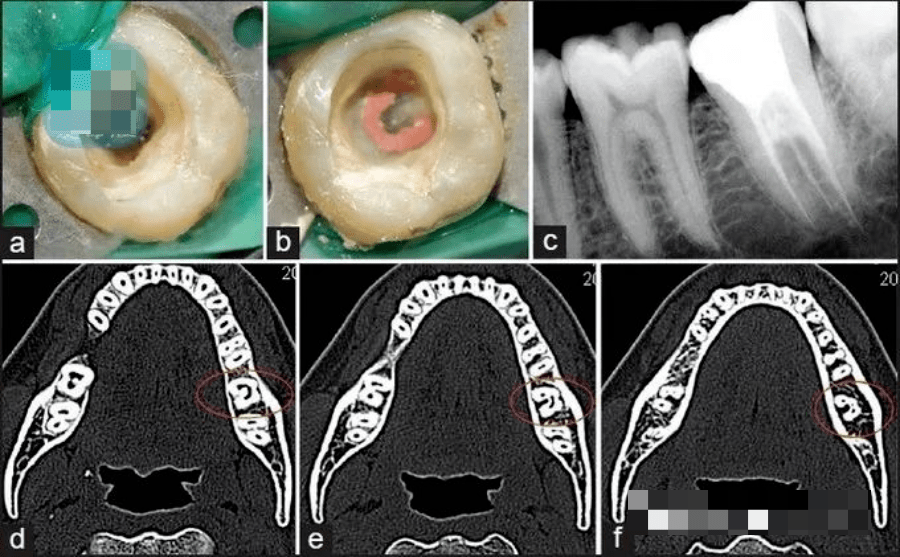 下颌磨牙c型根管的发现与治疗