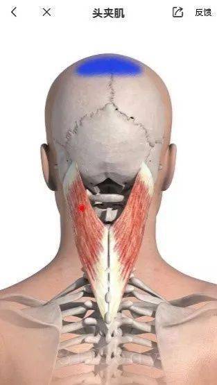 头夹肌的触发点可以引发头顶部疼痛☆图片来自3dbody胸锁乳突肌的触发