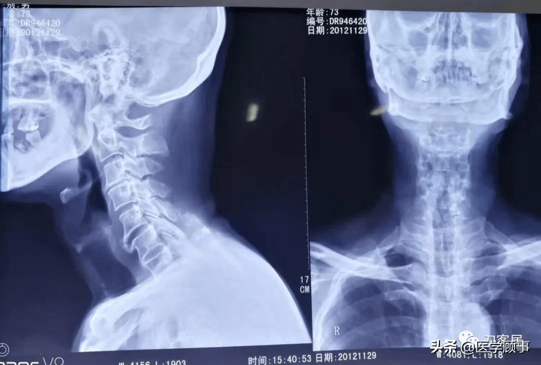 2012年11月29日颈椎管成形术前颈椎正侧位x线片,片子显示当时年龄是