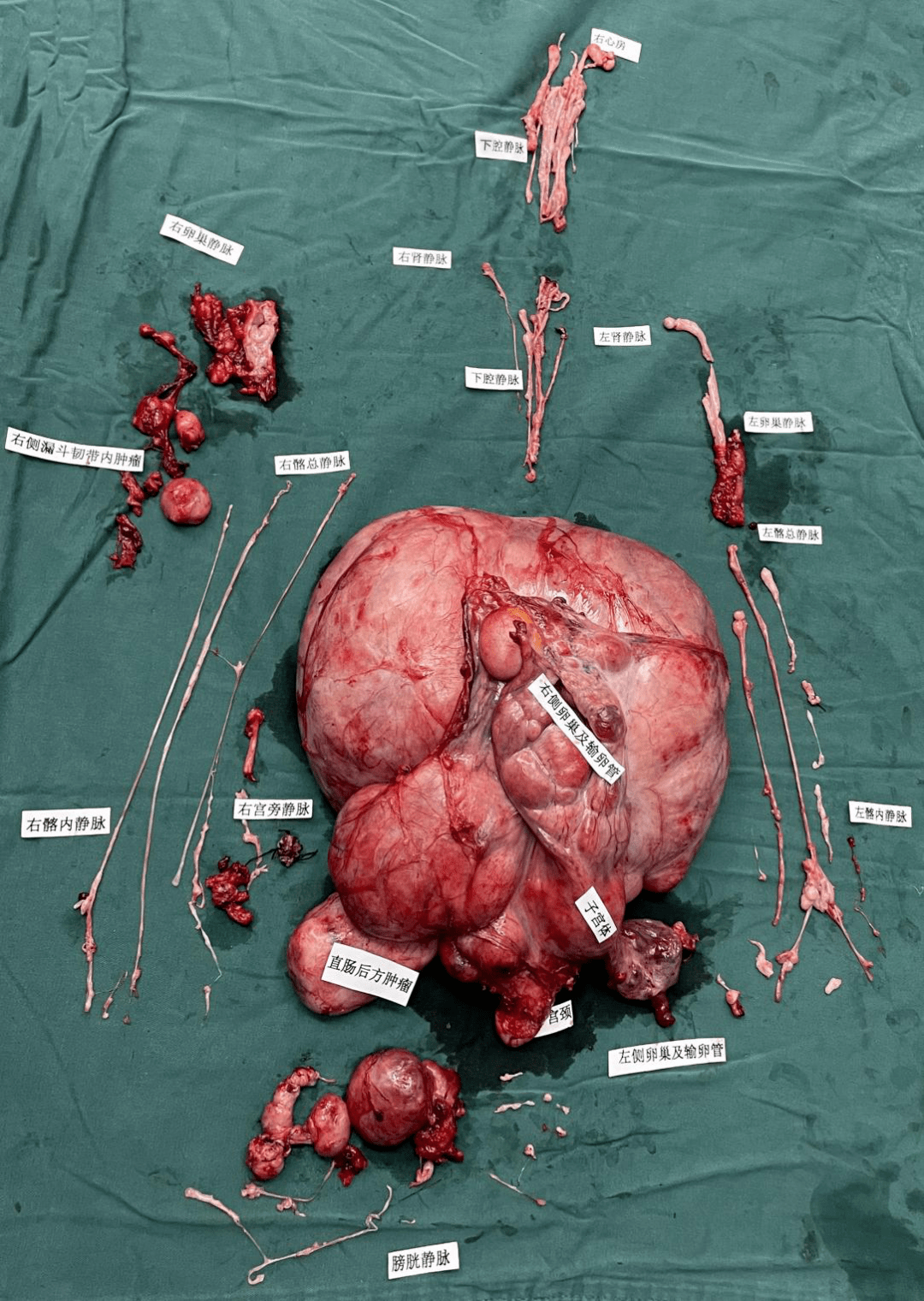 宫颈赘生物摘除术图片图片