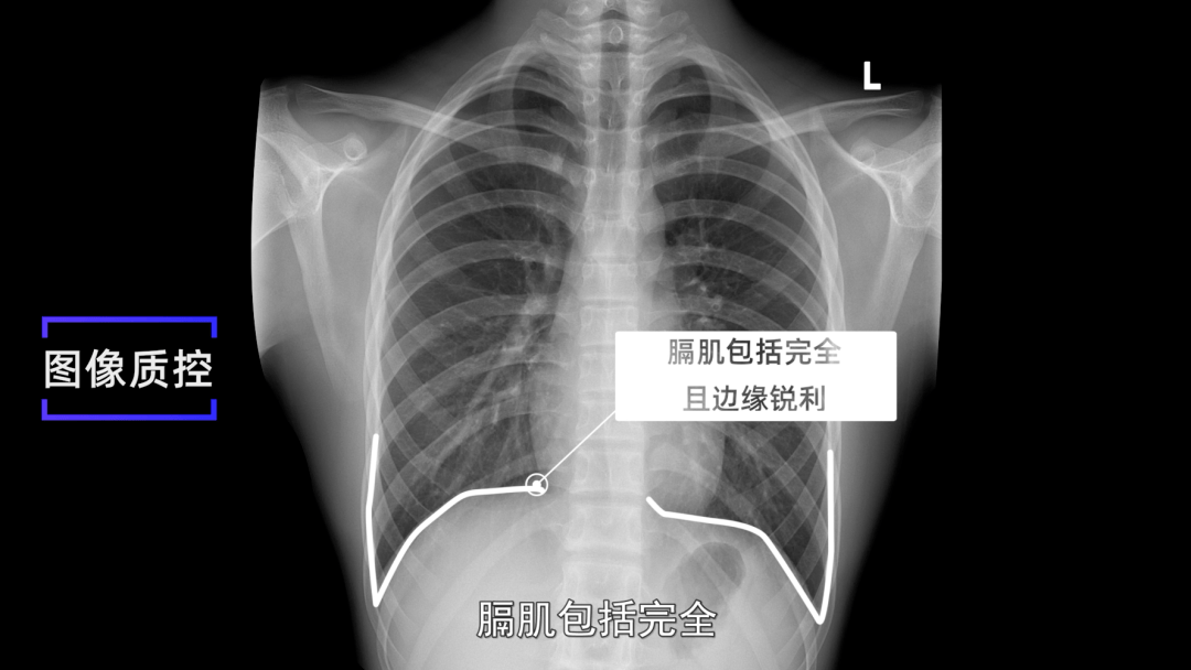 3. 肺尖充分顯示.2. 鎖骨,乳房,左心房內可分辨出肺紋理.