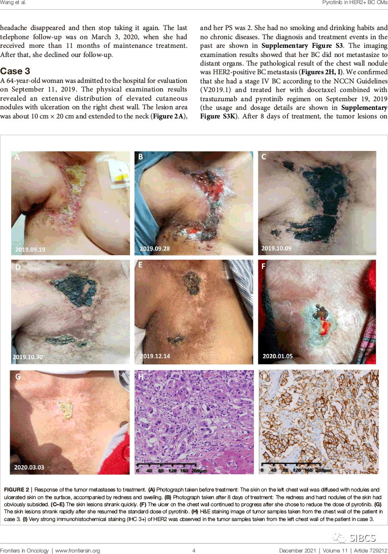 乳腺癌皮肤变化图片图片