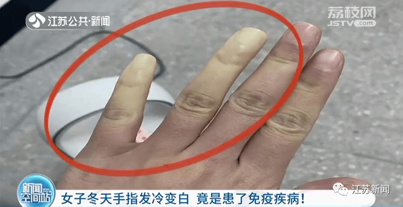 女子冬天手指发冷变白,冻伤了?其实是患了这种病!_雷诺_综合征_风湿