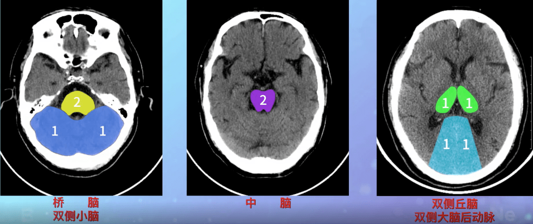 脑卒中临床评估量表教学视频:aspects评分量表