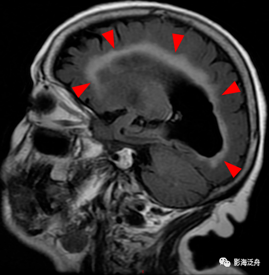 诊断|小心误诊，这可不是单纯的脑萎缩
