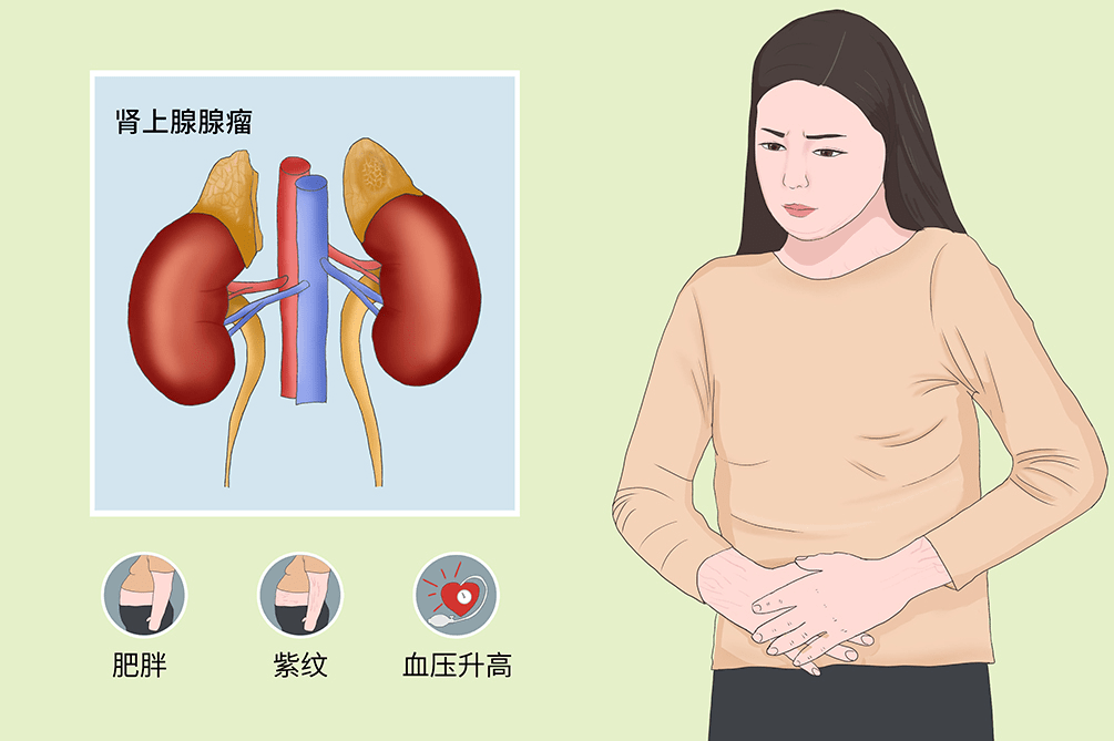 肾上腺_肿瘤_李先生