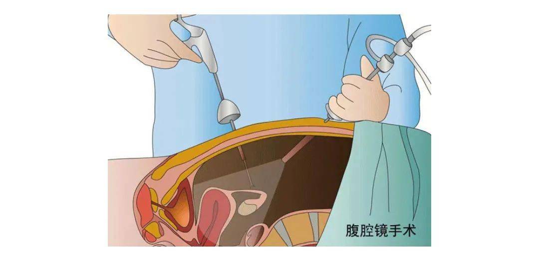 腹腔镜镜结构示意图图片