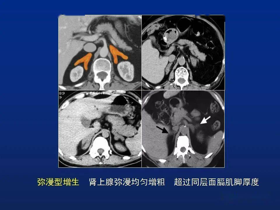 【医文医话】外二科:泌尿系小科普之肾上腺疾病_血压_监测_肿瘤