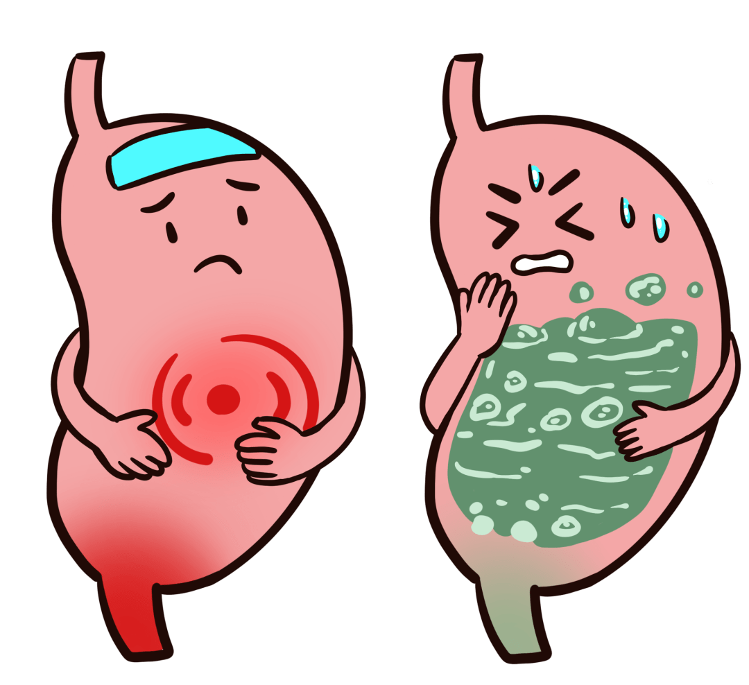 评价hp根除治疗:hp抗体 胃蛋白酶原ii同时下降(需停药2个月进行).