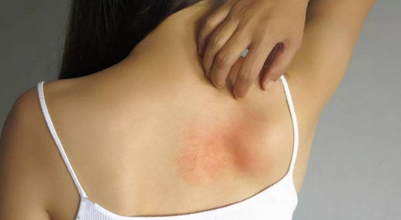 当这种东西在我们体内大量积聚时就会引起皮肤的瘙痒,尤其是在肝脏