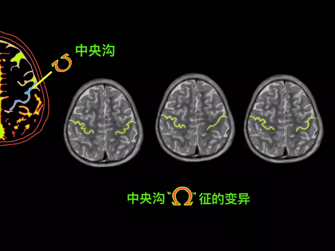 大脑中央沟体表定位图片