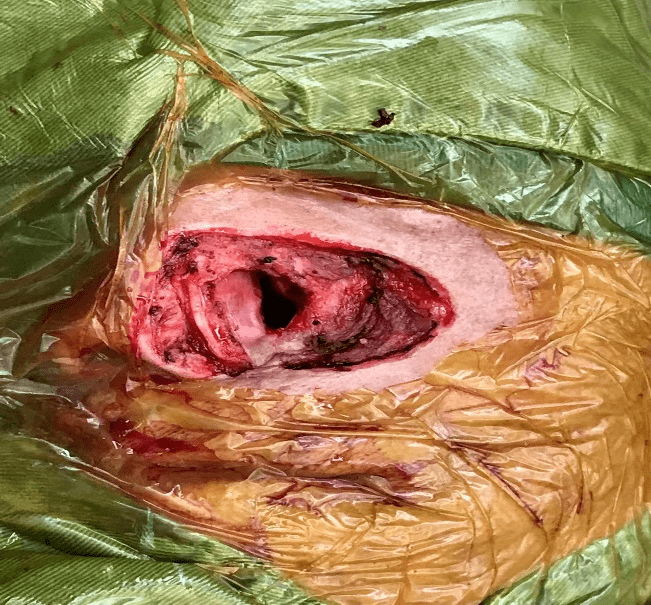 【技术分享】市一院专家妙手"鼻再造" 恶性肿瘤患者换新颜