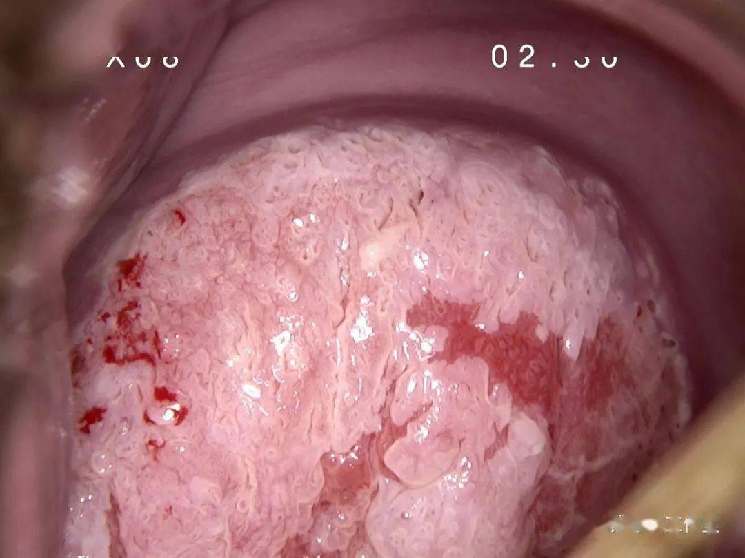 宫颈表面发黑图片图片