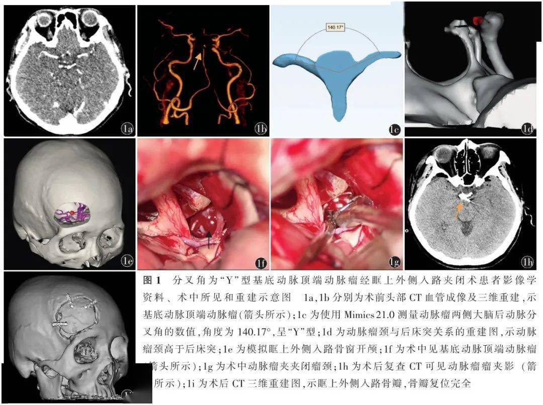 张鸿祺|中国脑血管病 | 眶上外侧入路夹闭后循环动脉瘤七例并文献复习