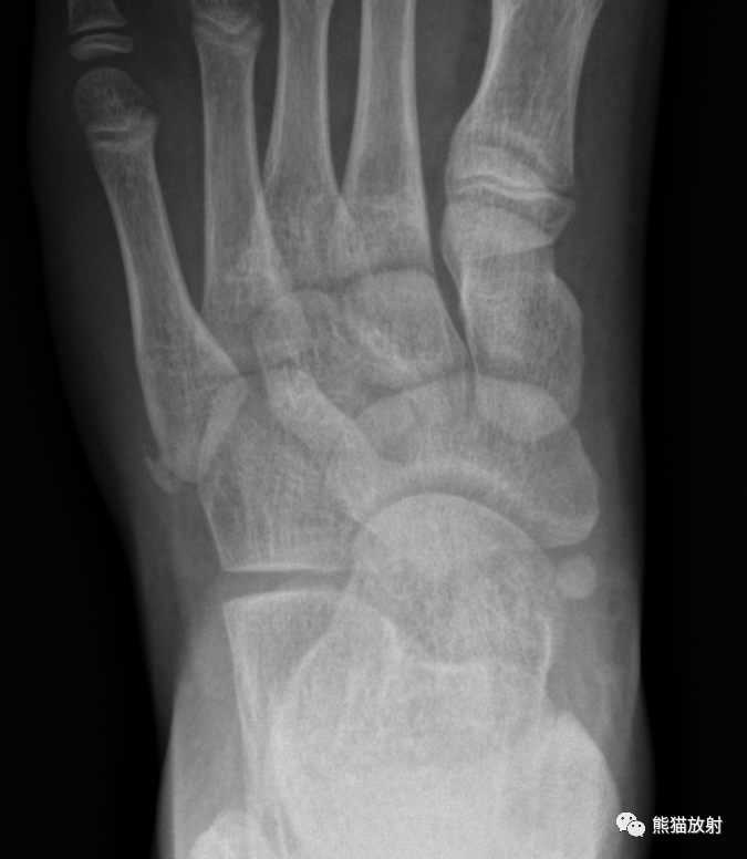 第五跖骨基底部骨折丨表现分型鉴别