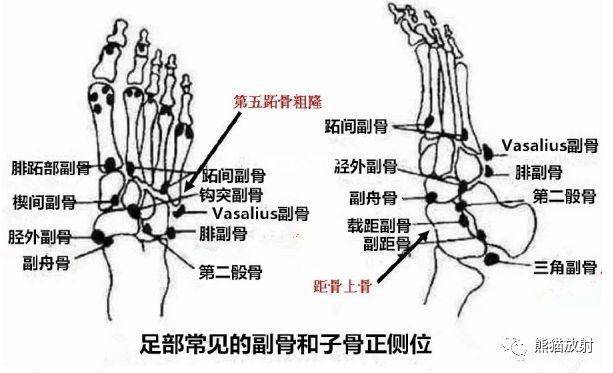第五跖骨基底部骨折丨表现,分型,鉴别