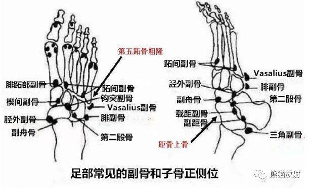 第五蹠骨基底部骨折丨表現,分型,鑑別~_肌腱_病例_腓骨