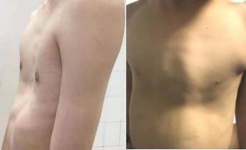 刘震|孩子“鸡胸、漏斗胸”不一定要手术，3D打印术定制“矫形”