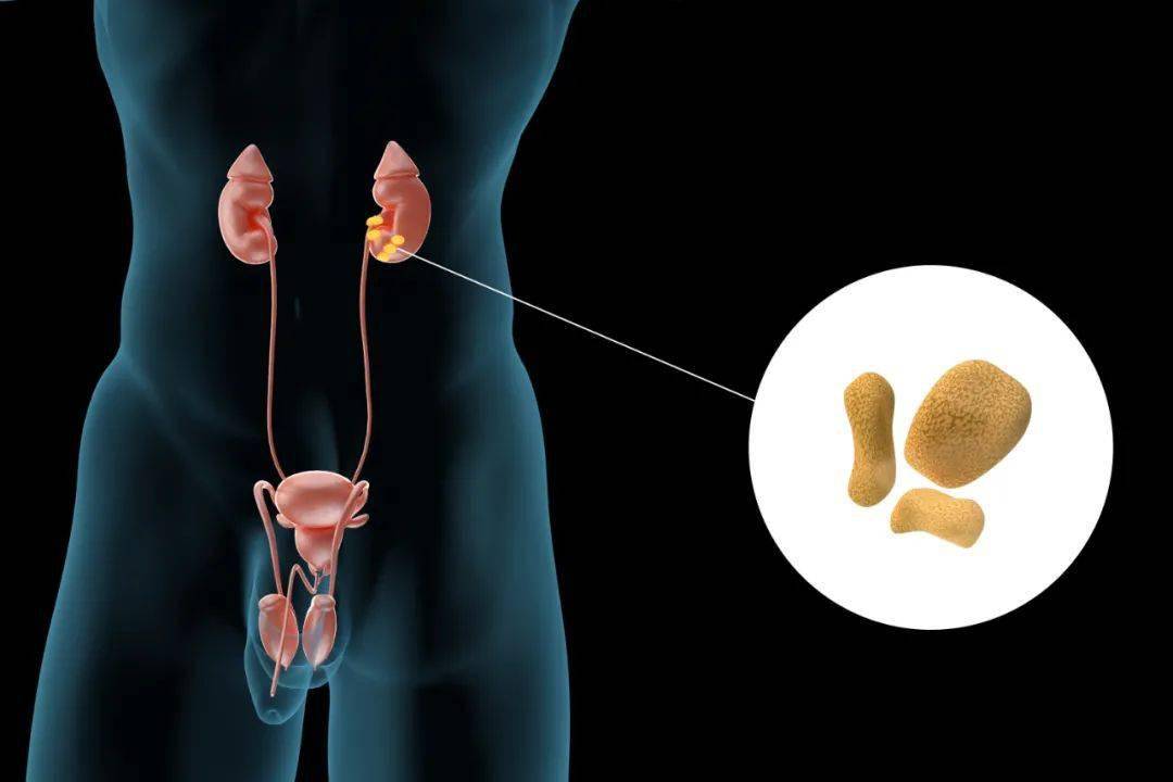症状|关于肾结石，你了解多少？