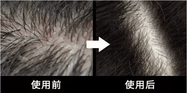 尸体头上抠下来的白泥竟是螨虫尸体!头痒头屑出油多,用它就对了