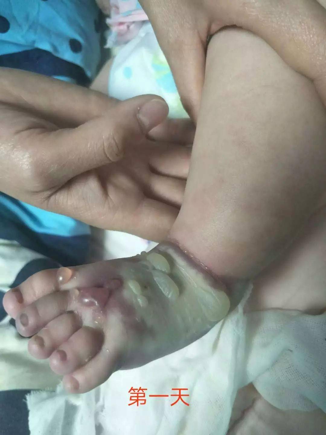 一例患儿输液渗漏的案例讨论_药液_局部_皮肤