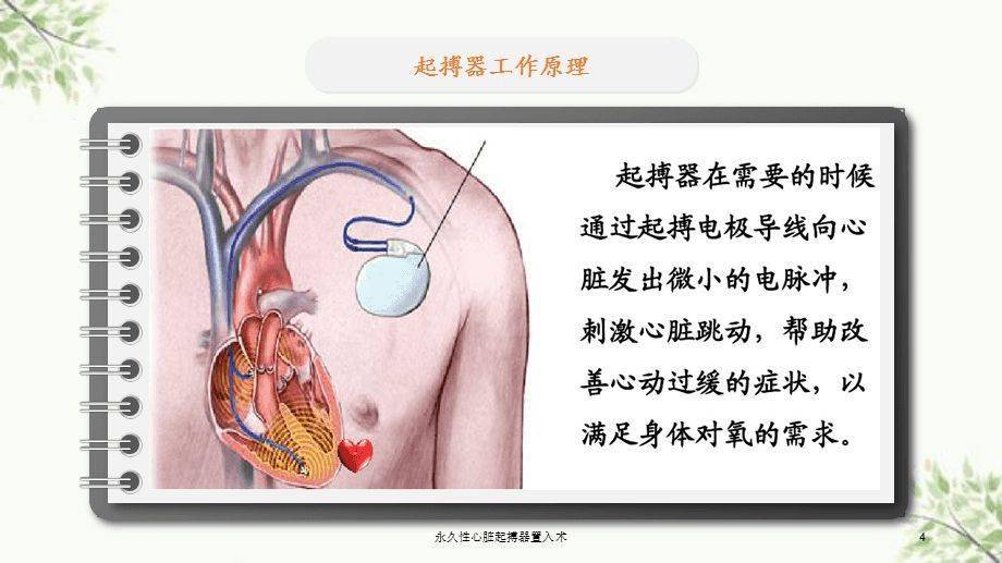 「科普」揭开心脏起搏器的神秘面纱