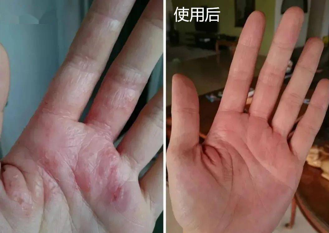 皮炎湿疹越挠越痒用它喷一喷3s止痒7天去疹除根不复发