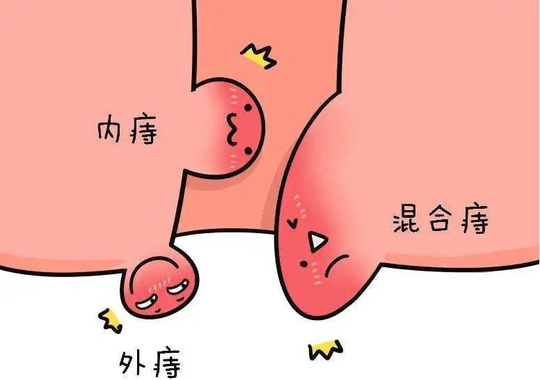 什么方法治痔疮最快 f38b585c76d540f6a32327e6730701e2.jpeg