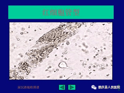 尿红细胞形态报告单图片