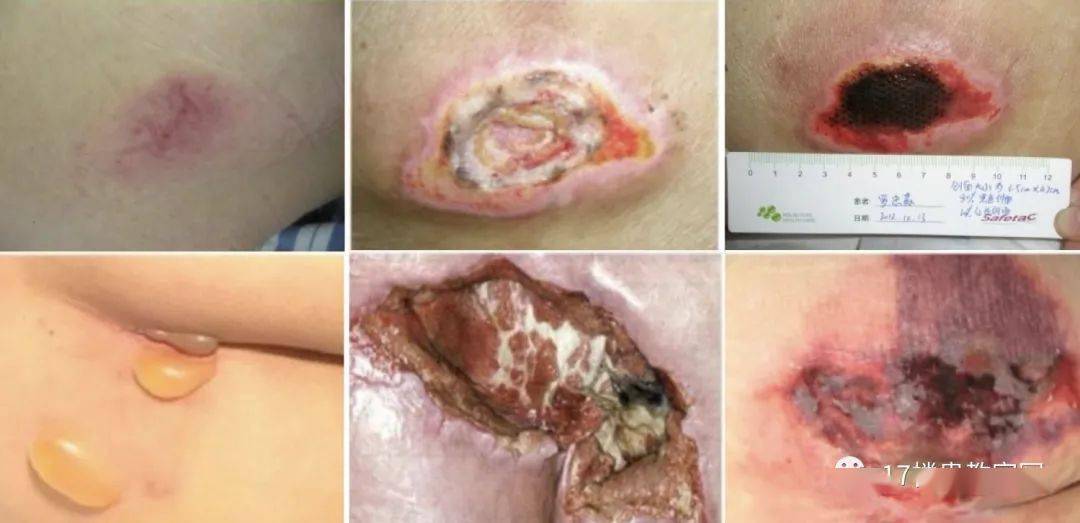 预防跌倒坠床及压力性损伤